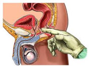 рак прямой кишки, пальцевое исследование