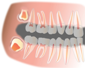 Зубы «мудрости»