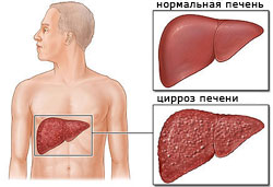 Цирроз печени