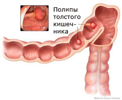 Полипы толстого кишечника и другие доброкачественные опухоли